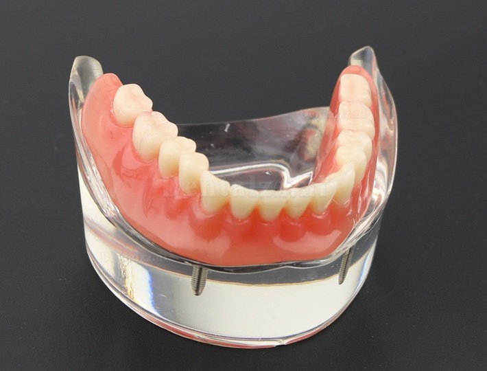 Tandentandenmodel Overdenture Inferieur met 2 implantaten Studiedemo Model 6002 01